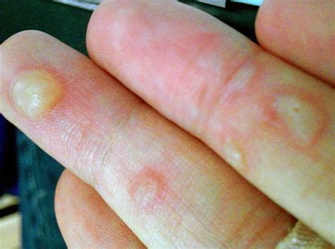 small blister like bumps on hands printable templates protal