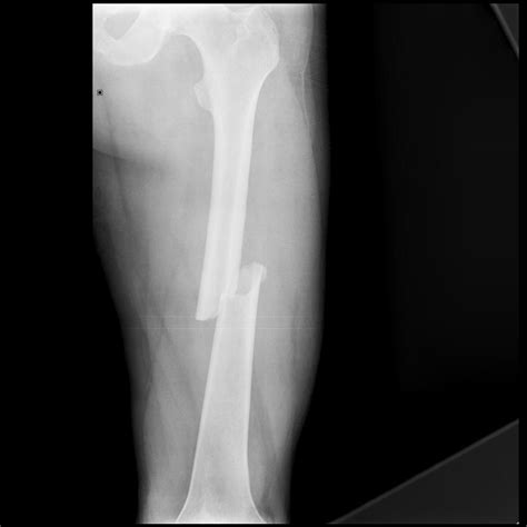 Spiral Bone Fracture X Ray Front Spiral Fractures Are The Result Of