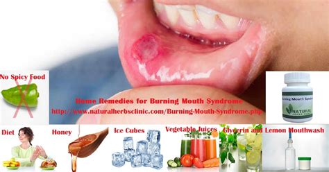 How Long Will The Burning Mouth Syndrome 6 Home Remedies For Burning Mouth Syndrome