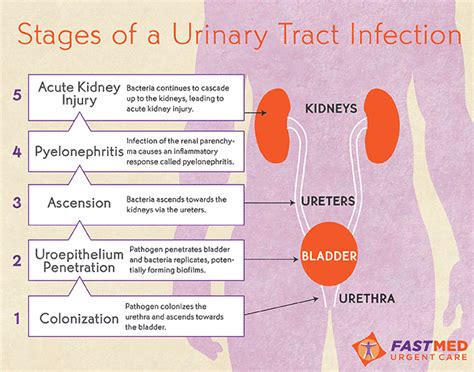 Stages Of Uti Urinary Tract Infection Urinary Tract Nursing Notes