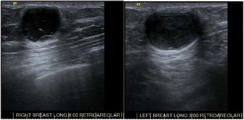 Bilateral Breast Ultrasound Demonstrating Subareolar Hypoechoic Masses