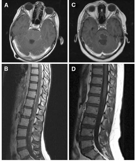 Spine And Brain Mri Scans Of A Patient With Known Florid Leptomeningeal