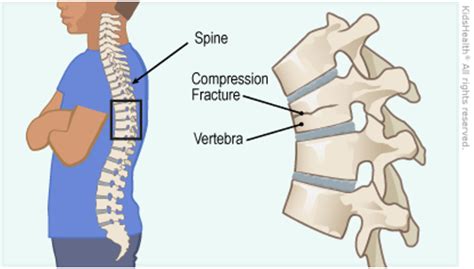 Vertebral Fractures In Children And Adolescents Physiopedia