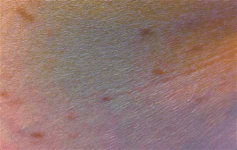 Clinical Urticaria Pigmentosa With Multiple Disseminated Red Macules On