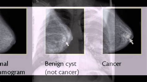 Breast Cancer X Ray Youtube