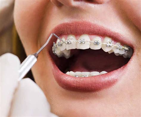 Costs of braces are determined based on a variety of factors that we will be able to determine at your visit. Cost Of Fastbraces | Best Dental in Houston, Texas