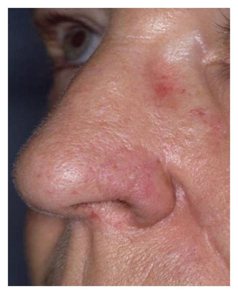 Reconstruction Of Nasal Skin Cancer Defects With Local Flaps