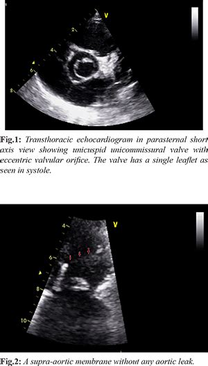 Unicuspid Acommissural Aortic Valve With Supra Aortic Membrane An