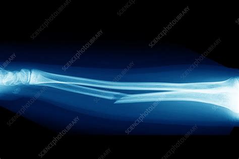 Broken Arm X Ray Stock Image C0018702 Science Photo Library