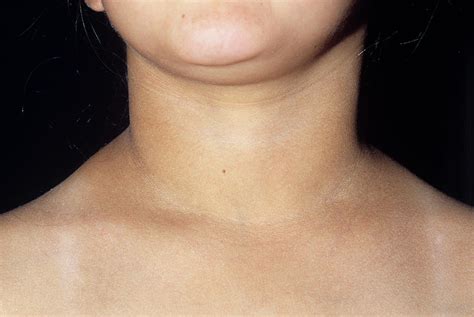 Hypothyroidism Photograph By Dr P Marazziscience Photo Library