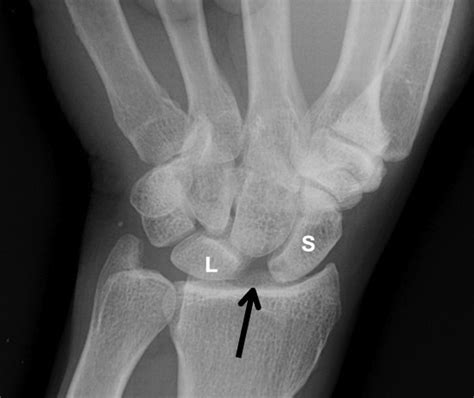 Lunate Dislocation Perilunate Dissociation Hand Orthobullets