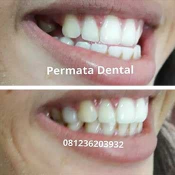 Melayani pembuatan gigi palsu servis gigi palsu. ahli gigi Bali | Proses Pemasangan Gigi Palsu | Pengen ...
