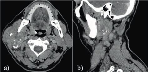 Sdc Of The Right Parotid Gland In A 65 Year Patient A Transverse And