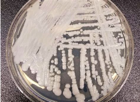 What Does Candida Auris Look Like On The Skin All About Deadly Fungus