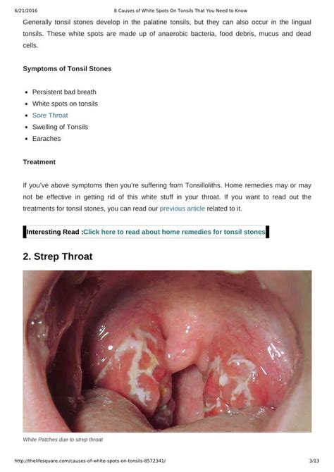 Ppt 8 Causes Of White Spots On Tonsils You May Not Know