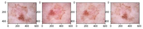 Skin Lesion Image Classification With Deep Convolutional Neural