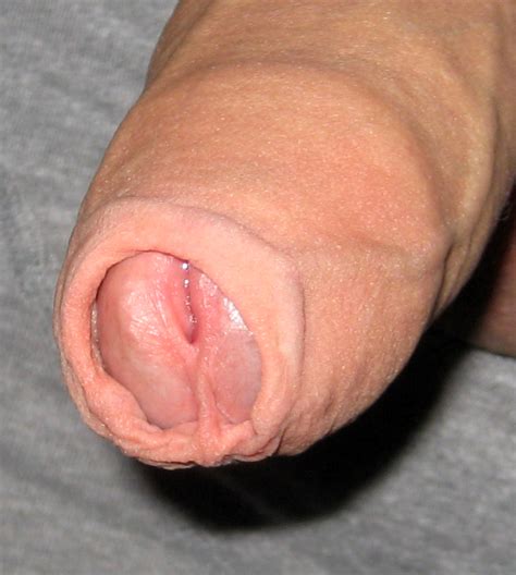 File Typical Foreskin High Resolution Wikimedia Commons