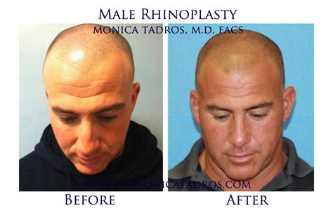 Follow these links to see photos of liposuction, brow lift, nose surgery, facelift, and other plastic surgery procedures. Male Rhinoplasty Before and After Photos of NJ Patients