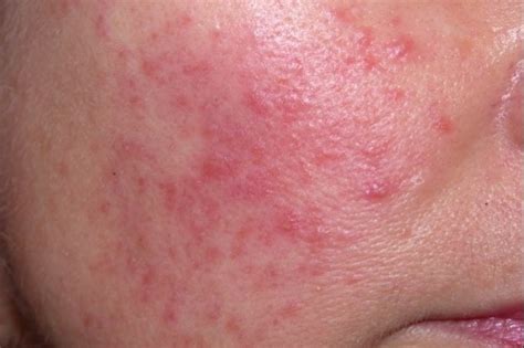 Red Spots On Face Treatment