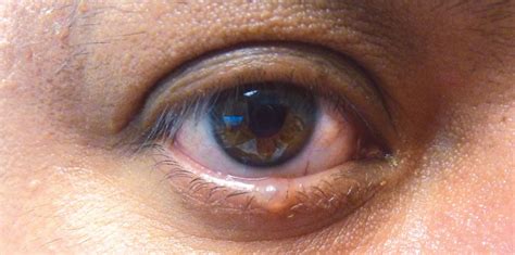 Bump Under Eyelid Skin Cancer Or Chalazion Cyst Scary Symptoms