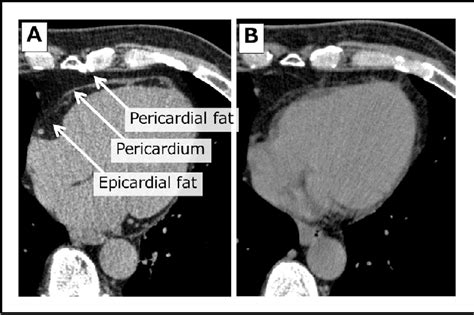 Epicardial Fat And Pericardial Fat Surrounding The Heart Have Different