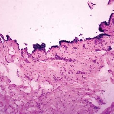 Pemphigus Vulgaris H And E Stained Section At 40× Showing Acantholytic