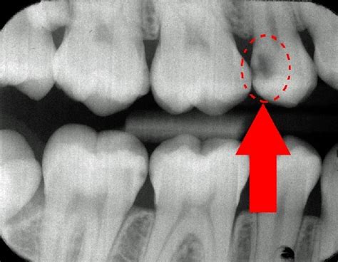 How To Read Dental X Rays Or Radiographs For Cavities