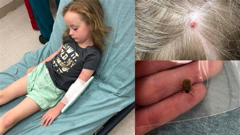 Mom Shares Warning After Tick Bite Hospitalizes Daughter