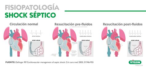 Cid De Choque Séptico Pulmonar