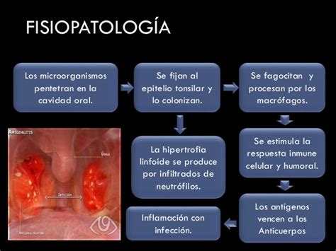 Fisiopatologia De La Amigdalitis Pdf