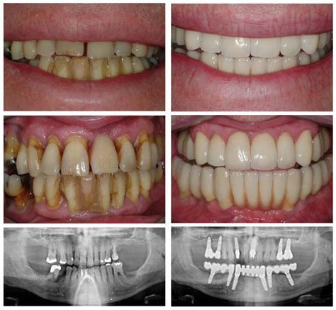 Treatment For Periodontal Disease Advanced Dentistry