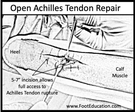 Achilles Tendon Diagram A Calf Injury Can Take Few Months To Heal If