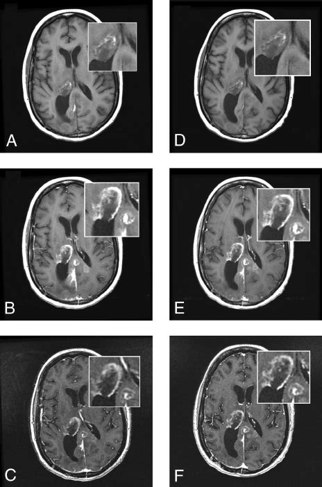 A 61 Year Old Man With Brain Metastases From Primary Lung Cancer