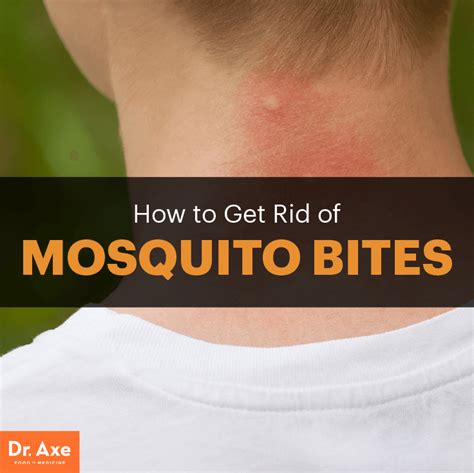 How To Get Rid Of Mosquito Bites Remedies For Mosquito Bites Home