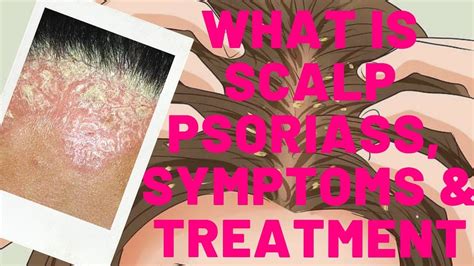 What Is Scalp Psoriasissymptoms And Its Treatment Youtube