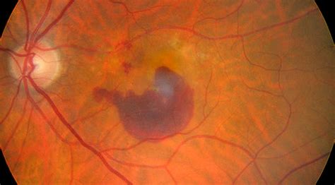 Wet Age Related Macular Degeneration Wet Amd Article