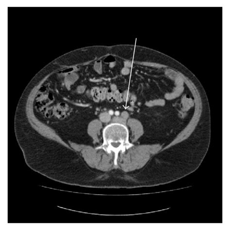 A Illustrated Ct Of The Abdomen With Pretreatment Lymphadenopathy