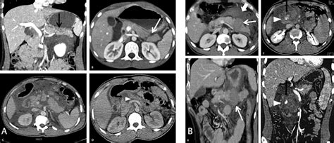 A Definite Computed Tomography Ct Signs Of Pancreatic Download