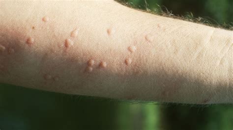 What Are Heat Hives And How Do You Get Rid Of Them Huffpost