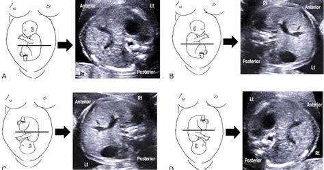 Bushras Ultrasound Blog Abdominal Circumference With Different Fetal Lies