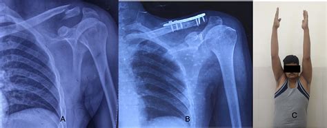 Cureus Clinical Outcome Of Neer Type Ii Lateral End Clavicle