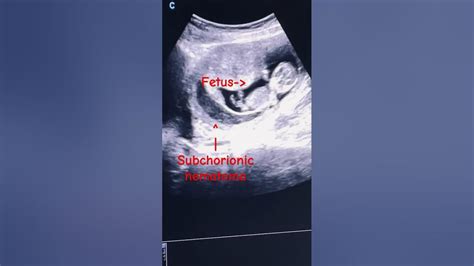 Subchorionic Hematomasubchorionic Hemorrhage 1st Trimester