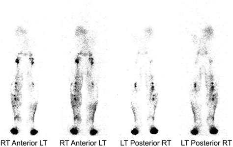 Lymphoscintigraphy Shows A Decreased Number Of Lymph Channels In The