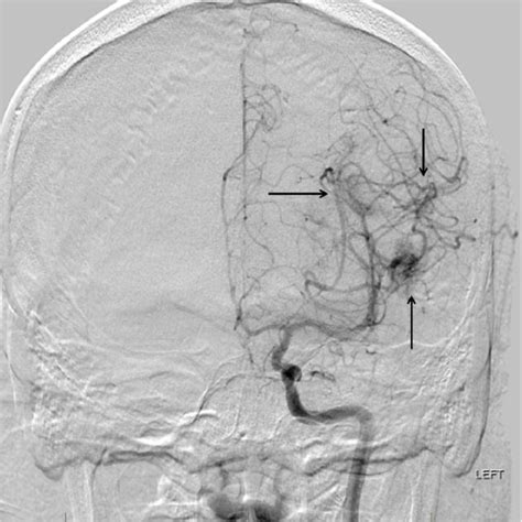 Left Internal Carotid Artery Digital Subtraction Angiography Dsa