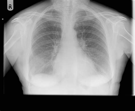 In this case of loculated pleural effusion (e), the configuration of the fluid suggests a free effusion more than a loculated effusion. Loculated pleural effusion | Image | Radiopaedia.org
