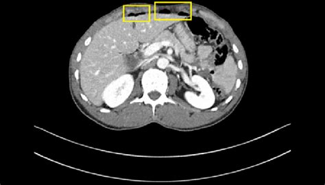 Computed Tomography Scan Of The Abdomen With Intravenous Contrast