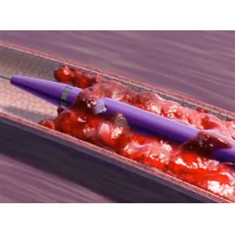 Angiojet™ Peripheral Thrombectomy System Boston Scientific