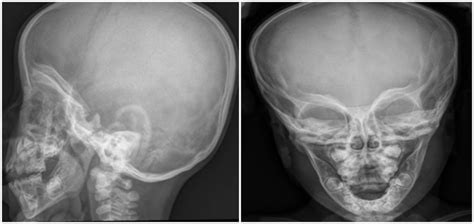 Cranial X Ray Shows Increased Biparietal Diameter Frontal Bossing