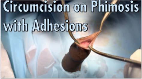 Circumcision Of Phimosis With Severe Adhesionsಅಂಟಿ ಹೋಗಿರುವ ಮುಂದೊಗಲಿಗೆ