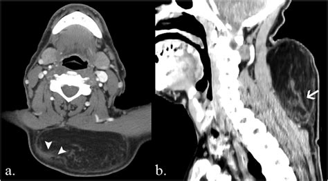 Spindle Cell Lipoma A Axial Post Contrast Ct And B Sagittal